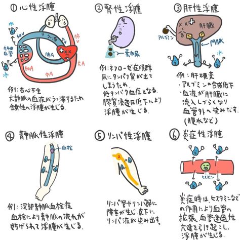 浮腫病|【浮腫とは？】浮腫の原因、メカニズム、治療・ケア。